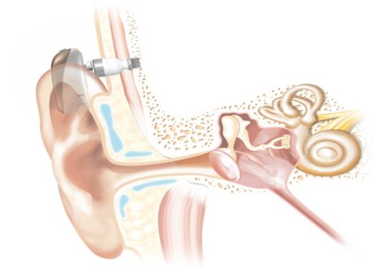 sự dẫn truyền xương âm thanh