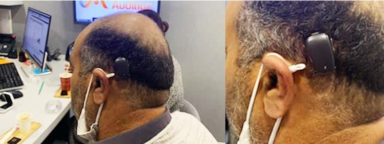 phản hồi bệnh nhân về ốc tai điện tử Cochlear BAHA 6